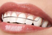 چه اقداماتی باید برای حفظ نتایج ارتودنسی انجام دهیم؟