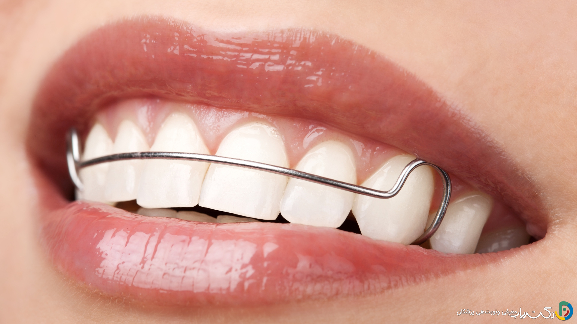 چه اقداماتی باید برای حفظ نتایج ارتودنسی انجام دهیم؟