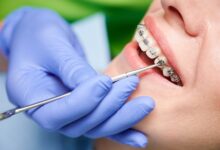 آیا بعد از درمان ارتودنسی به دندان پزشک نیاز داریم؟