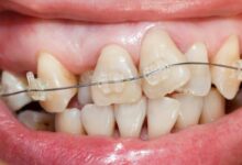 آیا ارتودنسی برای کسانی که دندان های کج دارند مناسب است؟