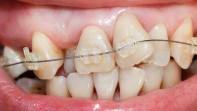 آیا ارتودنسی برای کسانی که دندان های کج دارند مناسب است؟