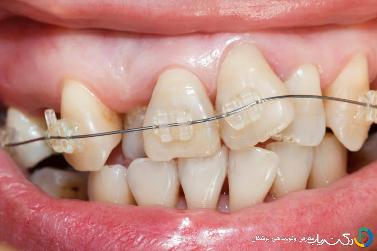 آیا ارتودنسی برای کسانی که دندان های کج دارند مناسب است؟