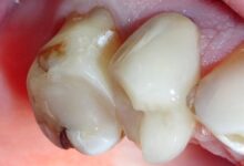 آیا ترمیم دندان درد دارد؟