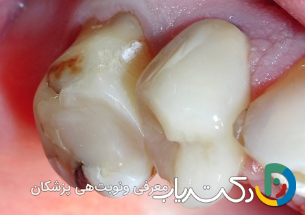 آیا ترمیم دندان درد دارد؟