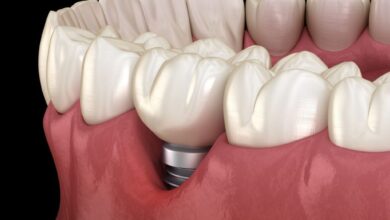امکان انجام ایمپلنت دندانی در افراد تحت درمان با داروهای ضدانعقاد
