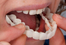 لمینت متحرک دندان چیست ؟ (مزایا و معایت آن)