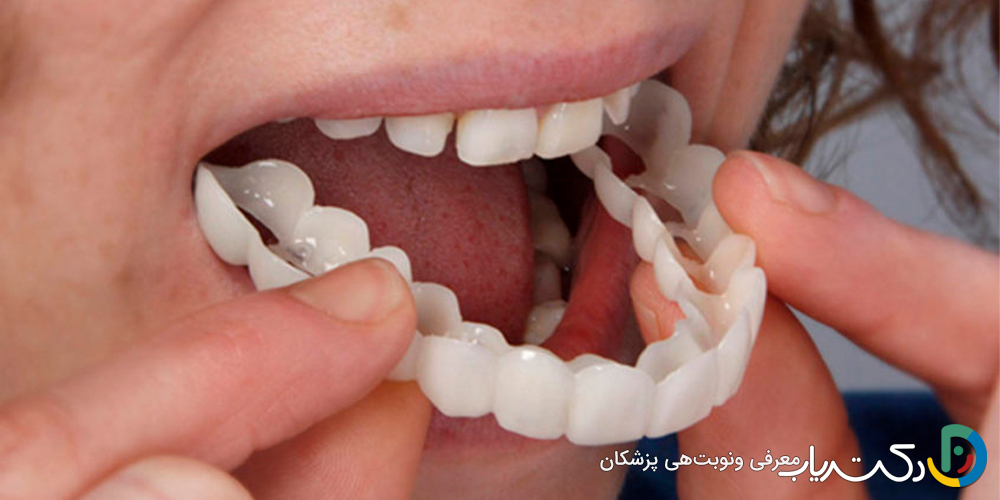 لمینت متحرک دندان چیست ؟ (مزایا و معایت آن)