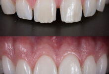 آیا باید دندان ها بعد از کامپوزیت حساسیت بیشتری پیدا کنند؟