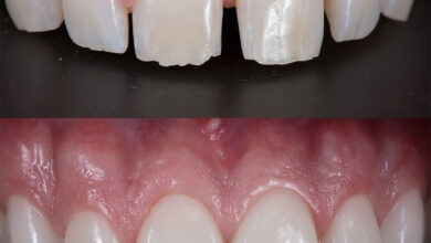 آیا باید دندان ها بعد از کامپوزیت حساسیت بیشتری پیدا کنند؟