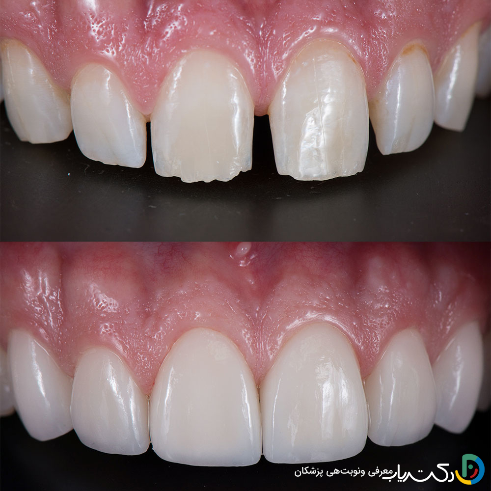 آیا باید دندان ها بعد از کامپوزیت حساسیت بیشتری پیدا کنند؟