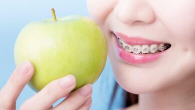 آیا باید رژیم غذایی خاصی برای ارتودنسی داشته باشیم؟