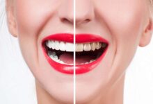 آیا تحقیقات جدید نشان دادهاند که بلیچینگ دندان برای دندانهای حساس مؤثر است؟