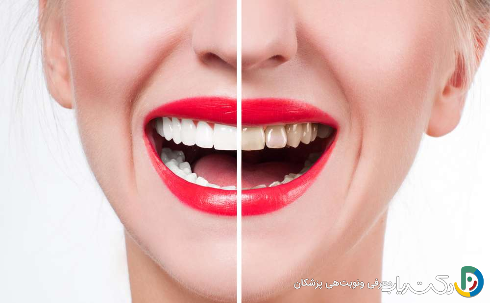 آیا تحقیقات جدید نشان دادهاند که بلیچینگ دندان برای دندانهای حساس مؤثر است؟