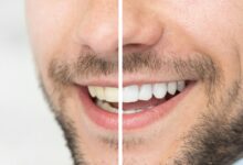 آیا بلیچینگ دندان نیاز به نگهداری خاصی دارد؟