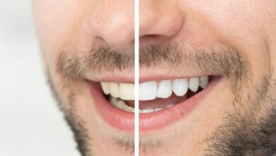 آیا بلیچینگ دندان نیاز به نگهداری خاصی دارد؟