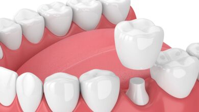 آیا باید دندان ها قبل از نصب روکش به طور کامل تراشیده شوند؟