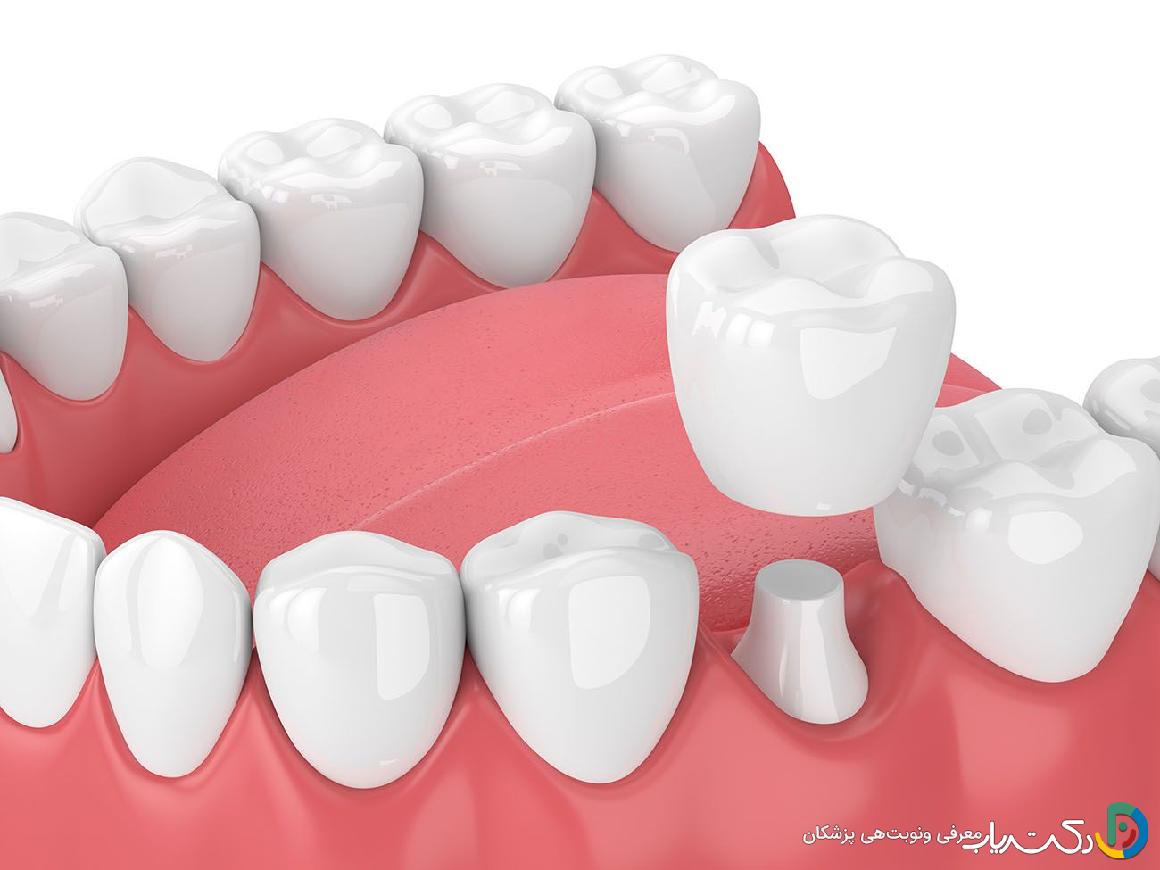 آیا باید دندان ها قبل از نصب روکش به طور کامل تراشیده شوند؟