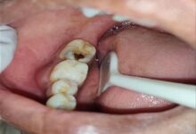 پوسیدگی دندان بعد از زایمان: علل، علائم و راههای پیشگیری