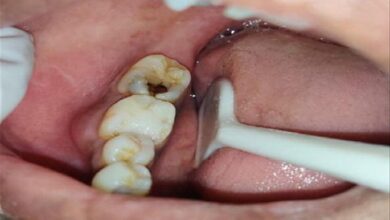 پوسیدگی دندان بعد از زایمان: علل، علائم و راههای پیشگیری