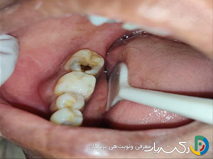پوسیدگی دندان بعد از زایمان: علل، علائم و راههای پیشگیری