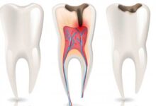 آیا عصب کشی دندان نیاز به جراحی دارد؟