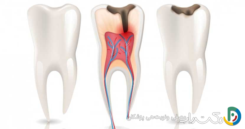 آیا عصب کشی دندان نیاز به جراحی دارد؟