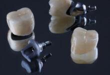 انواع روکش ایمپلنت دندان (مزایا و معایب آنها)