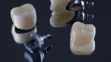 انواع روکش ایمپلنت دندان (مزایا و معایب آنها)