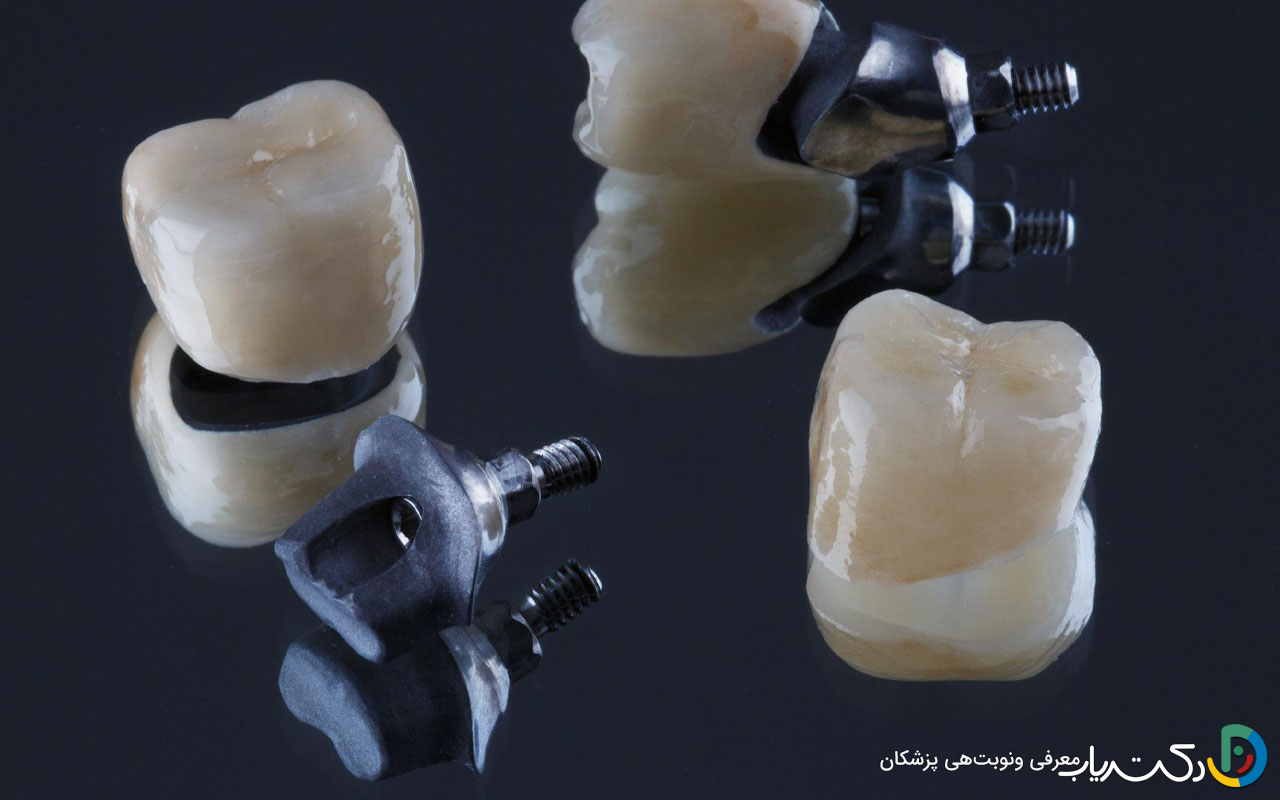 انواع روکش ایمپلنت دندان (مزایا و معایب آنها)