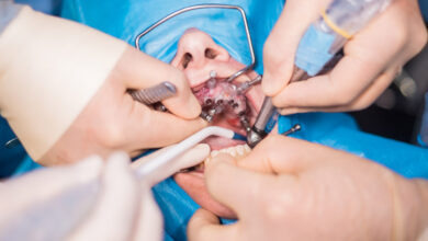 انواع جراحی دندان