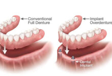 مزایای ایمپلنت دندان نسبت به دندان مصنوعی چیست؟