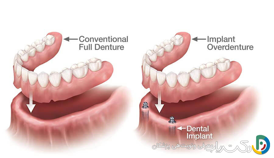 مزایای ایمپلنت دندان نسبت به دندان مصنوعی چیست؟