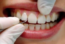 مزایای کامپوزیت دندان چیست؟