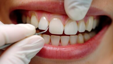 مزایای کامپوزیت دندان چیست؟