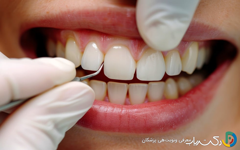 مزایای کامپوزیت دندان چیست؟