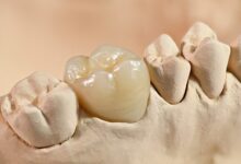 روکش دندان چه مزایایی دارد؟