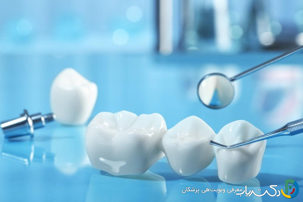 مزایای روکش دندان چیست؟