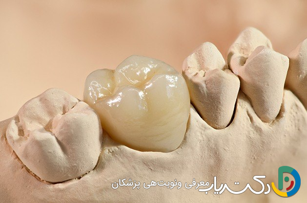 روکش دندان چه مزایایی دارد؟