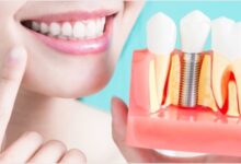 مزایای ایمپلنت دندان چیست؟ بررسی جامع فواید عملکردی، زیبایی و سلامتی