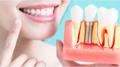 مزایای ایمپلنت دندان چیست؟ بررسی جامع فواید عملکردی، زیبایی و سلامتی