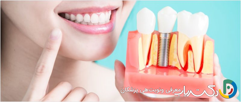 مزایای ایمپلنت دندان چیست؟ بررسی جامع فواید عملکردی، زیبایی و سلامتی