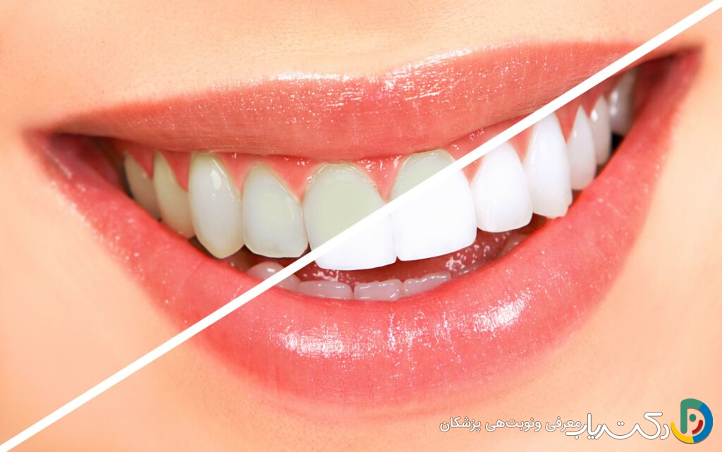 مزایای بلیچینگ دندان چیست؟