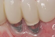 عوارض ایمپلنت دندان چیست ؟