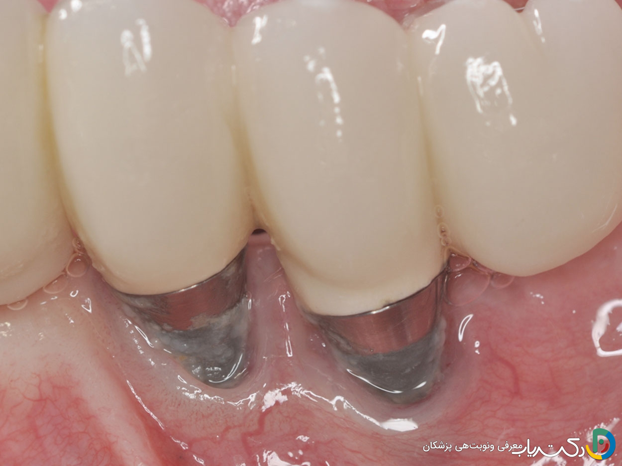 عوارض ایمپلنت دندان چیست ؟