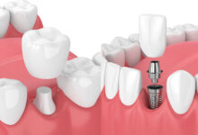 چه تفاوت هایی بین روکش دندان و ایمپلنت دندان وجود دارد؟