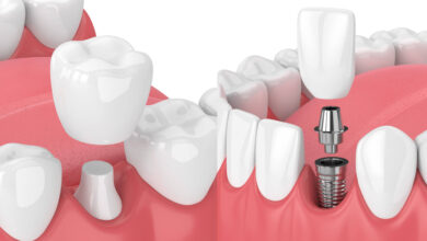 چه تفاوت هایی بین روکش دندان و ایمپلنت دندان وجود دارد؟