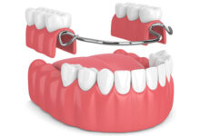 چه تفاوت هایی بین دندان مصنوعی و بریج وجود دارد؟