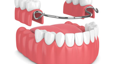 چه تفاوت هایی بین دندان مصنوعی و بریج وجود دارد؟