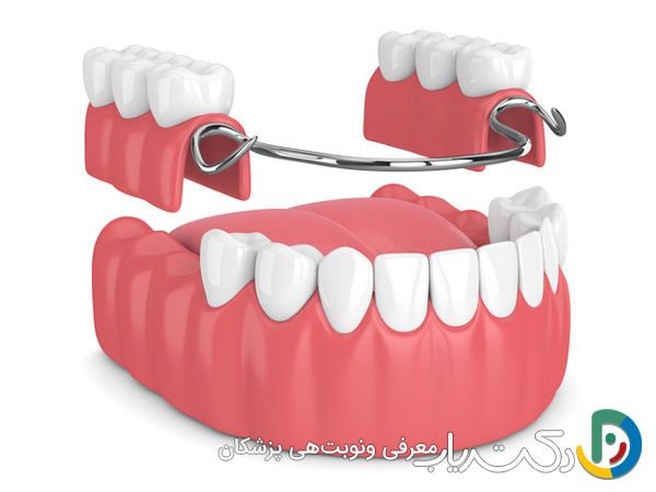 چه تفاوت هایی بین دندان مصنوعی و بریج وجود دارد؟