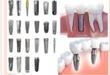 انواع برندهای ایمپلنت دندان کره ای، سوئیسی، آلمانی، آمریکایی چه